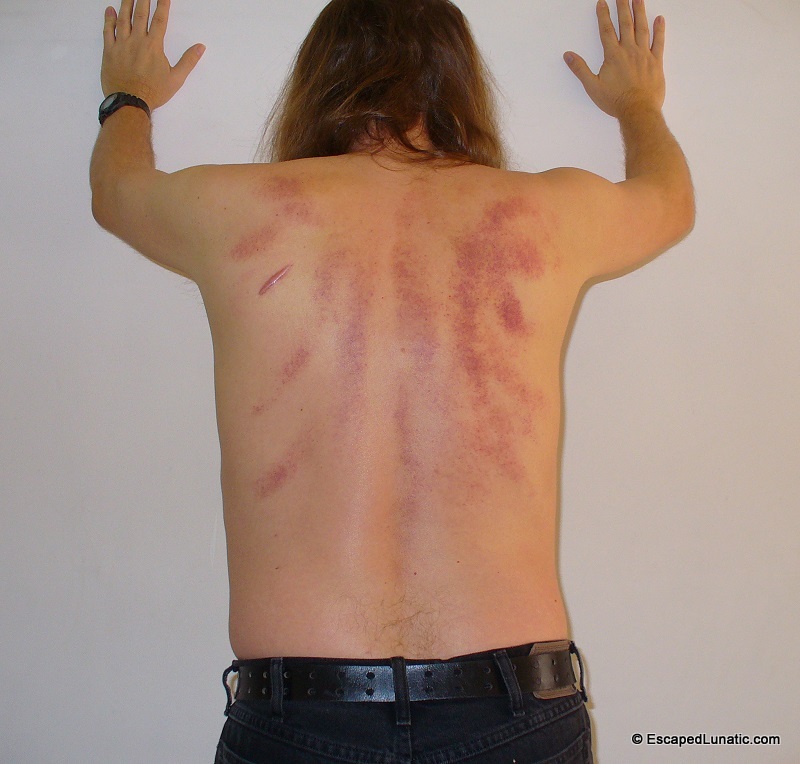 Back scraping - more masochistic fun at a foot massage place