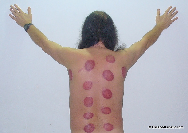 Squid Attack? No, I got fire cupped during a foot massage :-)